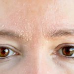 Rogowacenie skóry – dlaczego skóra się łuszczy i jak należy ją pielęgnować?