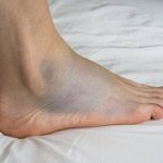 Co może być przyczyną puchnięcia kostek u nóg?