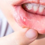 Co to jest grzybica jamy ustnej i jak się ją diagnozuje?